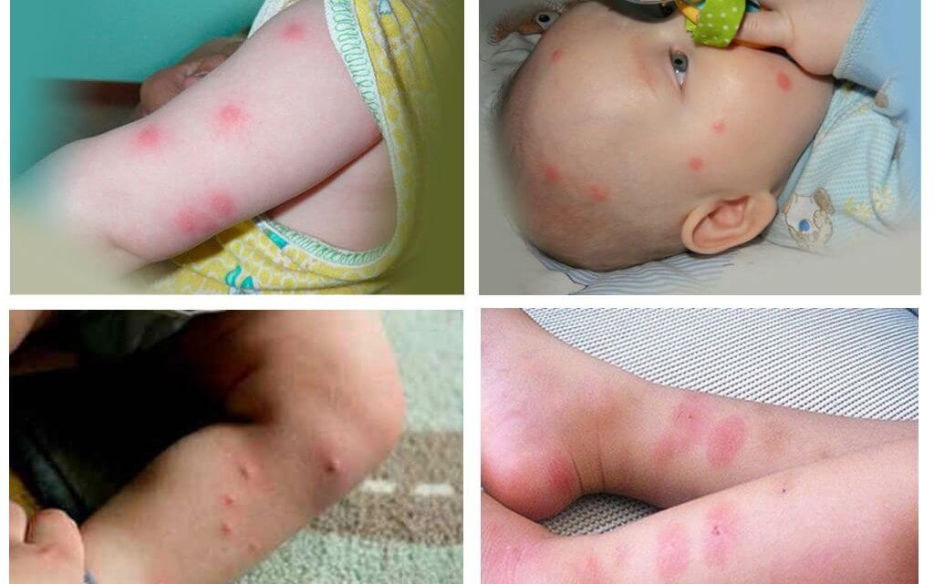 Các triệu chứng khi bé bị bọ chét cắn và cách chữa trị