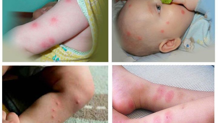 Các triệu chứng khi bé bị bọ chét cắn và cách chữa trị