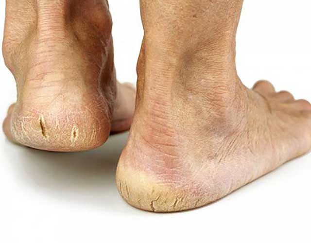 Phương pháp điều trị nứt gót chân đơn giản ngay tại nhà
