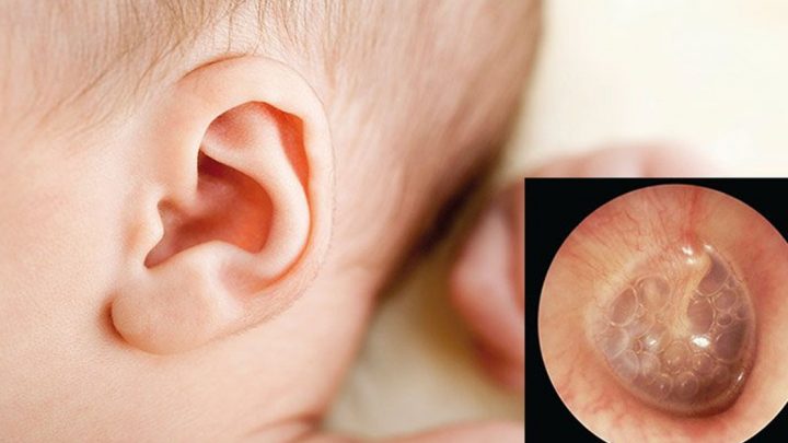 Viêm tai – một trong những bệnh lý cha mẹ cần quan tâm